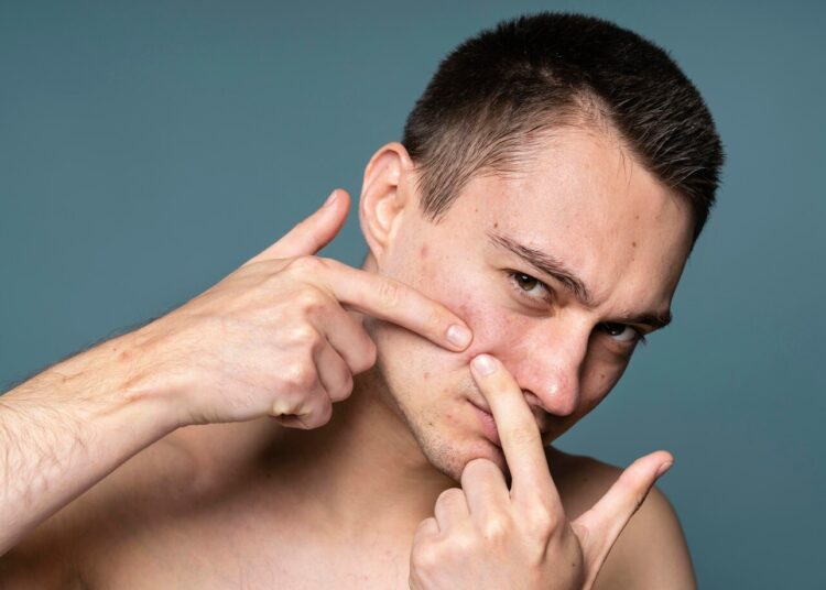 Banyak yang Gak Tahu, Ini Penyebab Munculnya Jerawat di Muka!