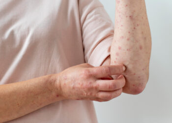 Gini Cara Mencegah Alergi Dingin Kambuh, yang Sering Gatal-Gatal Atau Bersin Merapat!