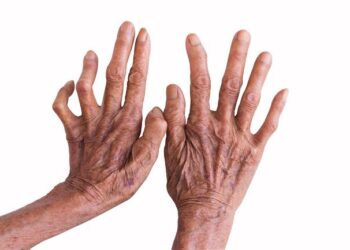 Kuningan Menuju Daerah Bebas Kusta, Tercatat 39 Penderita yang Tersebar di 19 Kecamatan