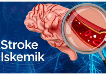 Ini Gejala Umum dan Penanganan Cepat Stroke Iskemik