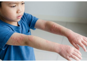 Ini Penyebab dan Cara Mengatasi Kaligata pada Anak