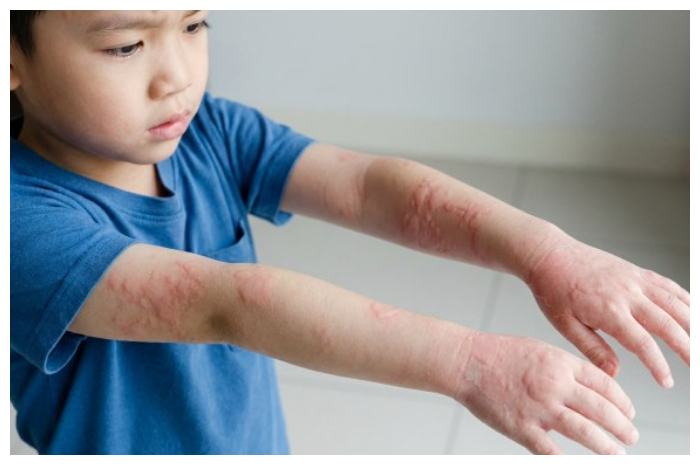 Ini Penyebab dan Cara Mengatasi Kaligata pada Anak