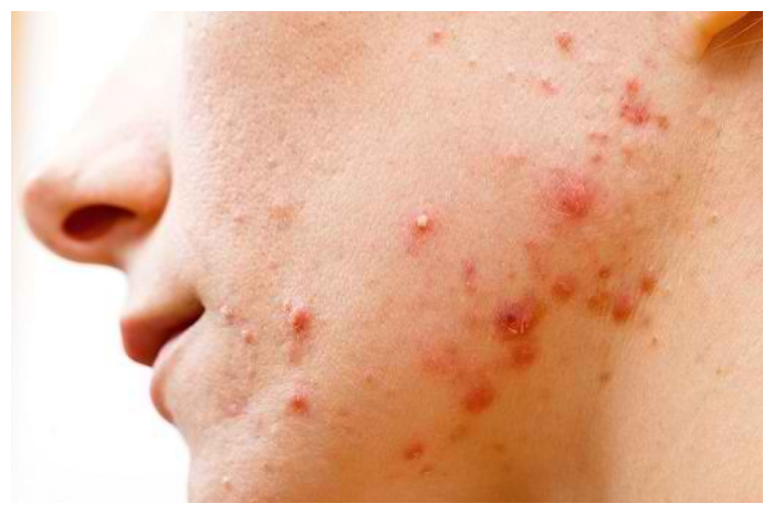 Jerawat Pasir Bikin Tak Percaya Diri? Begini Cara Mengatasinya