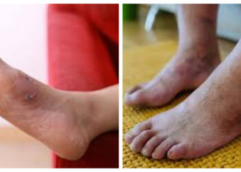 Tips Merawat Luka Diabetes untuk Menghindari Komplikasi Serius