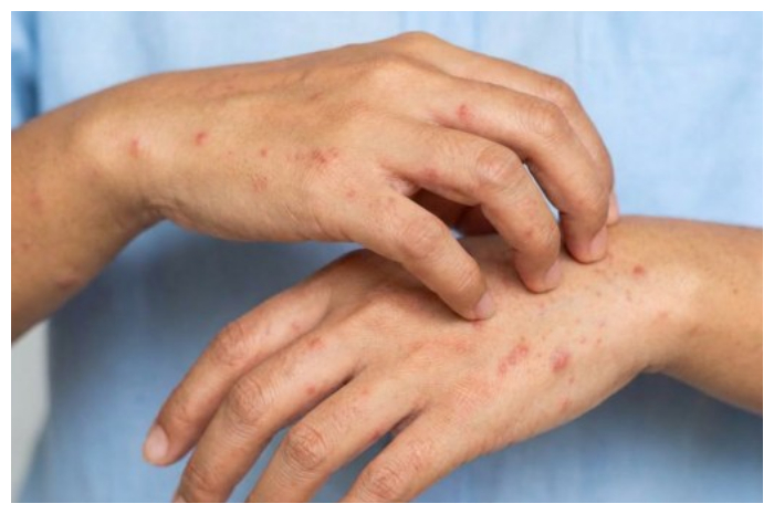 Jangan Salah Kaprah, Ini Perbedaan Ruam Kulit Biasa dan HIV!