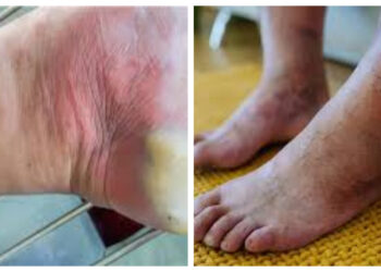 WASPADA! Perubahan Tubuh Ini Bisa Menandakan Diabetes Memburuk