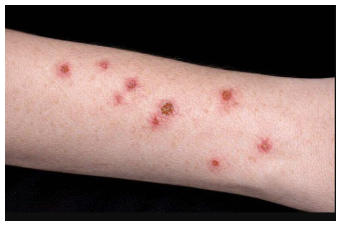 Waspada! Ini Tanda-Tanda Darah Manis yang Perlu Diketahui