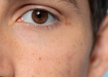 Cek Cara Jitu Mengatasi Milia di Wajah, Ampuh dan Efektif!