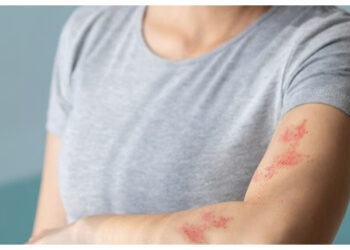 Alergi Dingin Kambuh? Ini Cara Mengatasinya dengan Mudah