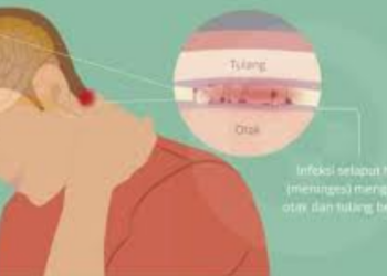 Jangan Abaikan! Kebiasaan Sehari-hari Ini Bisa Picu Meningitis 4 Jangan Abaikan! Kebiasaan Sehari-hari Ini Bisa Picu Meningitis