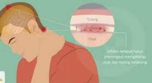Jangan Abaikan! Kebiasaan Sehari-hari Ini Bisa Picu Meningitis 1 Jangan Abaikan! Kebiasaan Sehari-hari Ini Bisa Picu Meningitis