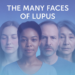 Mengenal Lupus, Penyakit Autoimun yang Berjuluk “Penyakit Seribu Wajah”
